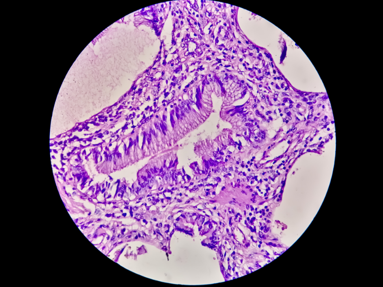 Virtual staining of cancer tissue